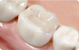 被せ物・詰め物で治療した歯