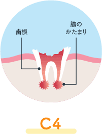 歯の根っこだけになるまで進行したう蝕（C4）