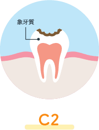 象牙質う蝕（C2）