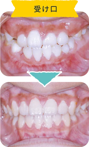 ②下顎前突（受け口）｜下の歯が上の歯より前方へ突出