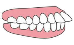 Q3.インビザラインGOができない症例は？出っ歯や口ゴボは治る？