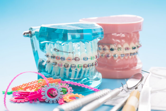歯列矯正の器具・装置はどんな種類や特徴がある？