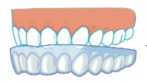 キレイラインは軽度～中程度の症例対応！上下前歯12本を整えることがメイン