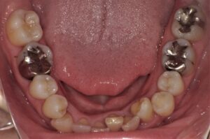 症例2治療前下顎