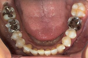 症例2治療後下顎
