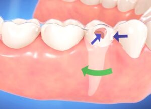 2. 「アタッチメント」を歯の表面に接着して歯の角度・向きを細かく調整