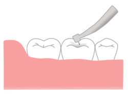 3. 治療が終わっていない歯は事前に治しておく