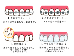1. 自分に合った歯列矯正の種類を選択する