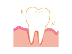 1. 「歯根吸収（歯の根っこが短くなる）」が起こり、歯がグラグラしはじめるリスク
