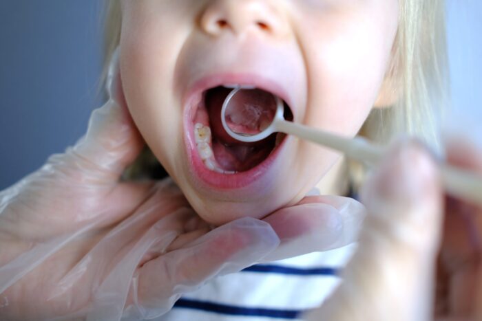 6歳臼歯が痛いときの対処法は？起こりうる5つのトラブルの原因についても解説！