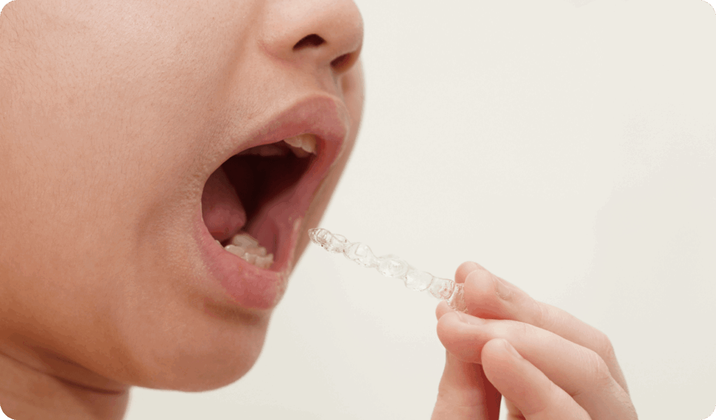 マウスピース矯正