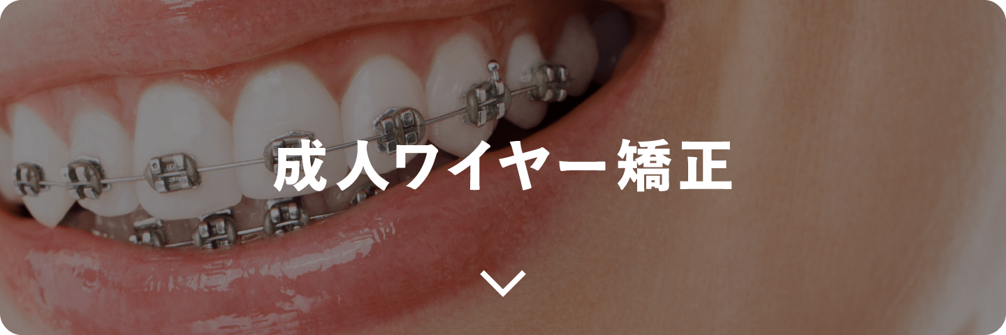 成人ワイヤー矯正
